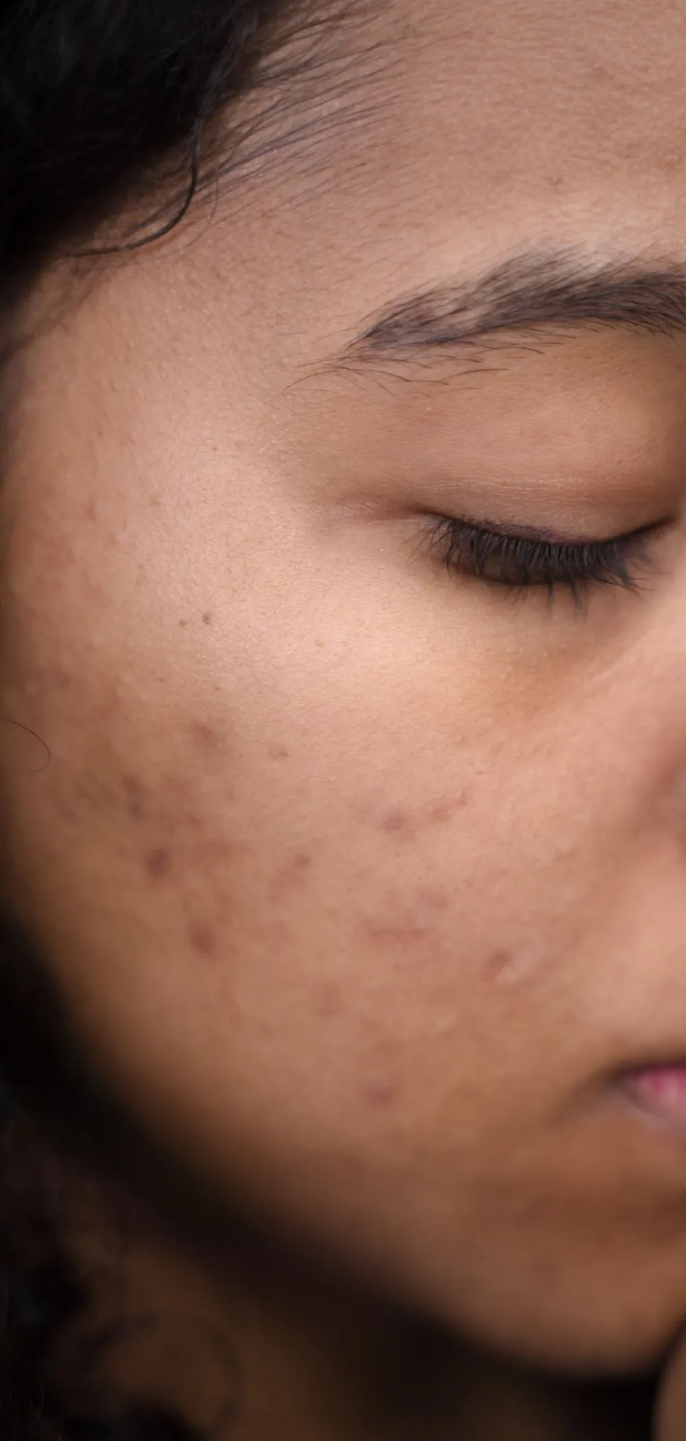 Can Acne Scars Really Be Improved? Understanding Your Options