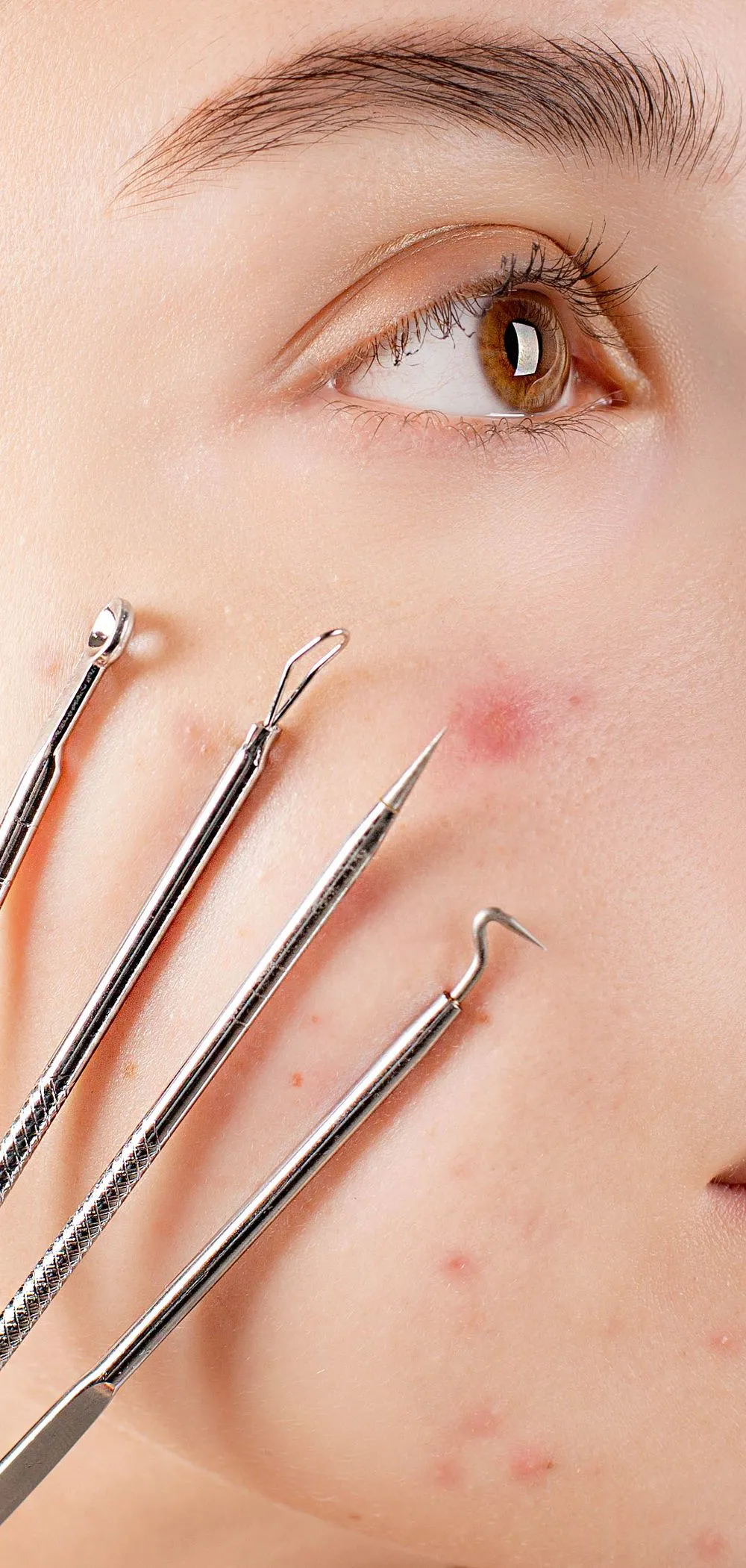 5 Common Skincare Mistakes That Can Make Acne Worse