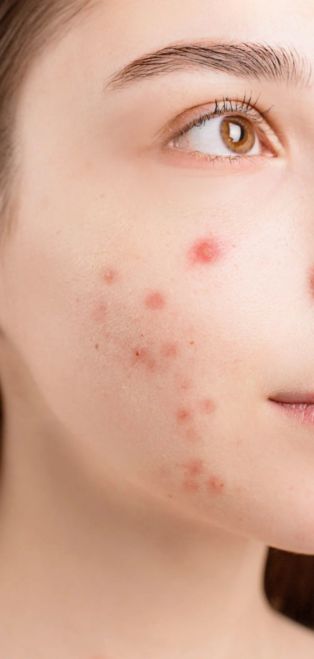 Why Does Acne Keep Coming Back? A Dermatologist's Guide